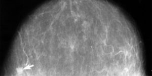 Mammogram van borstkanker in een vroeg stadium