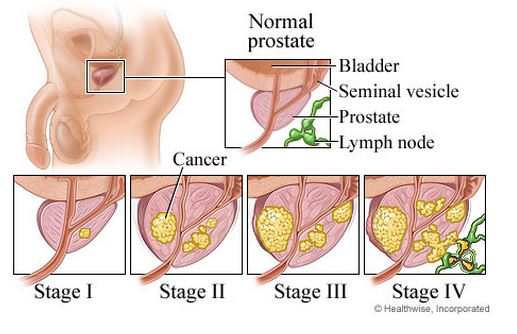 Celdeling bij prostaatkanker. Foto: Healthwise, Incorporated
