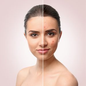 CBD ultieme oplossing acne