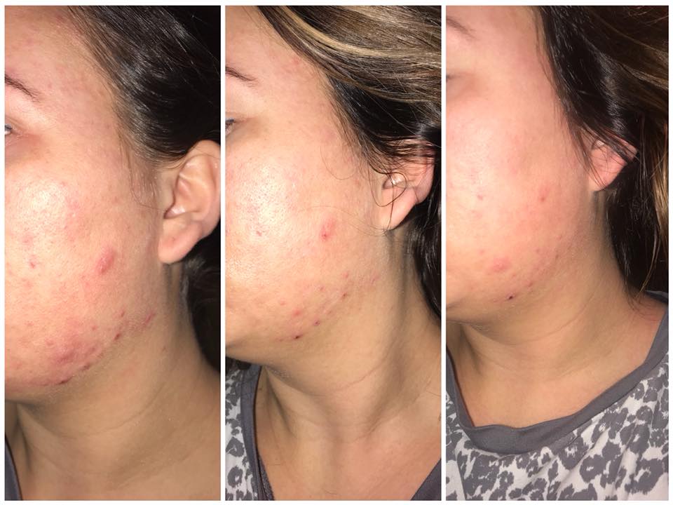 Frustrerend Lenen Super goed CBD-crème helpt Maureen van acne af - Mediwietsite